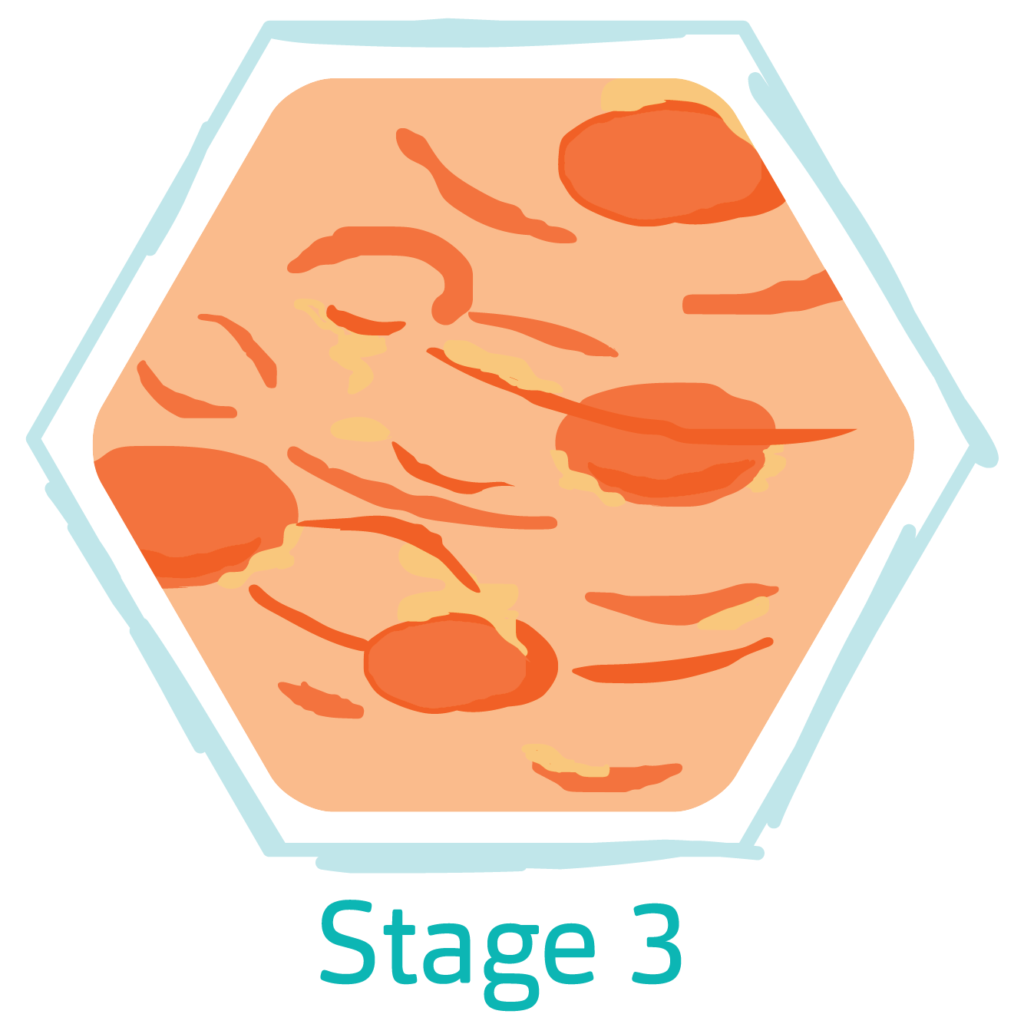 Hidradenitis Suppurativa Stages HidraWear