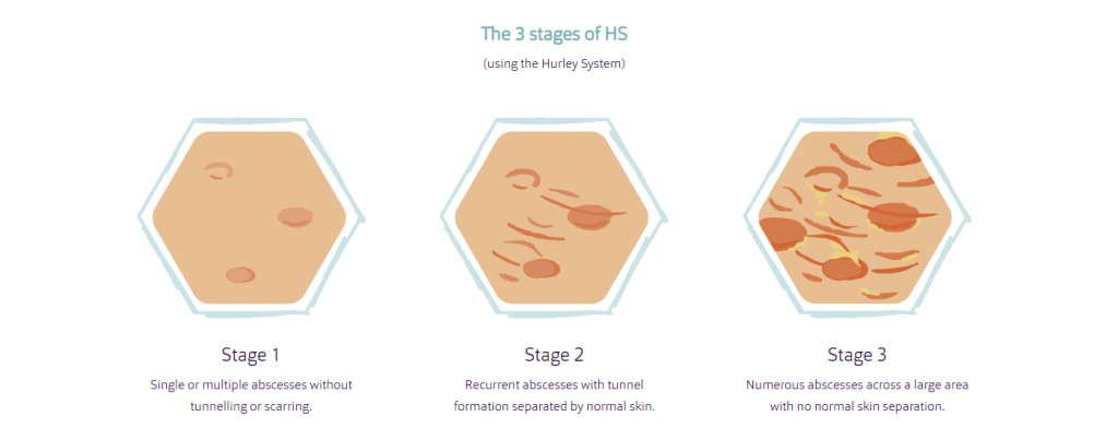 Hidradenitis Suppurativa Stages Hidrawear