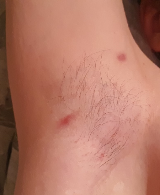 Hidradenitis Suppurativa Pictures - HidraWear