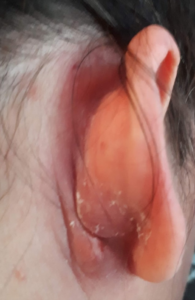 hidradenitis suppuratvia picture ear