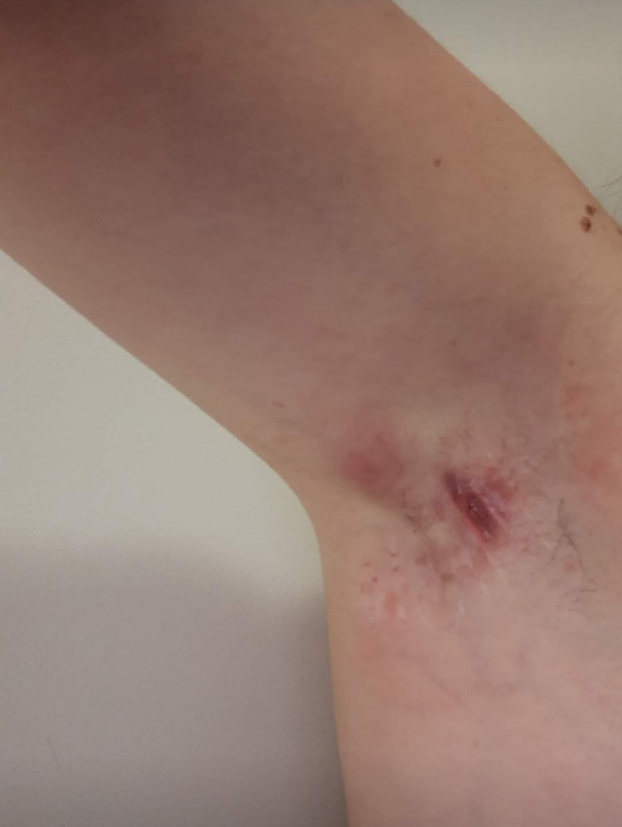Hidradenitis Suppurativa Pictures - HidraWear