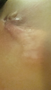 hidradenitis suppuratvia picture scar