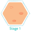 Hidradenitis Suppurativa Stages - HidraWear