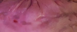 stage 3 hidradenitis suppurativa skin lesions