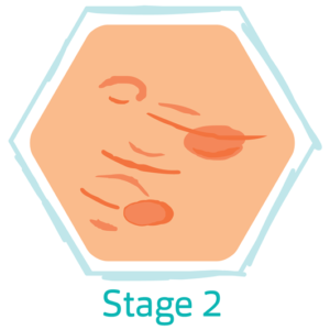 Hidradenitis Suppurativa Stage 2