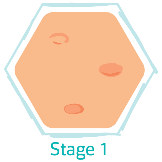 Hidradenitis Suppurativa Stage 1