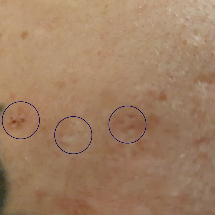 Clusters of blackheads
