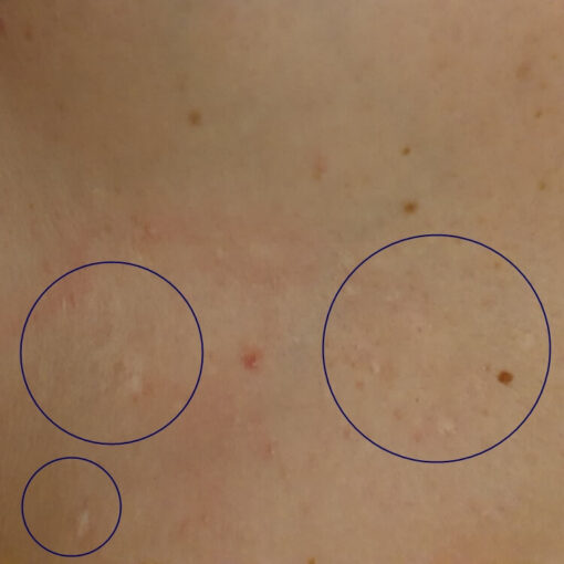 Pictures Of Hidradenitis Suppurativa - HidraWear