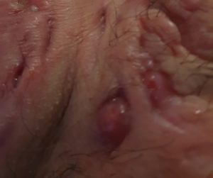 Hypergranulation Hidradenitis suppurativa wound care