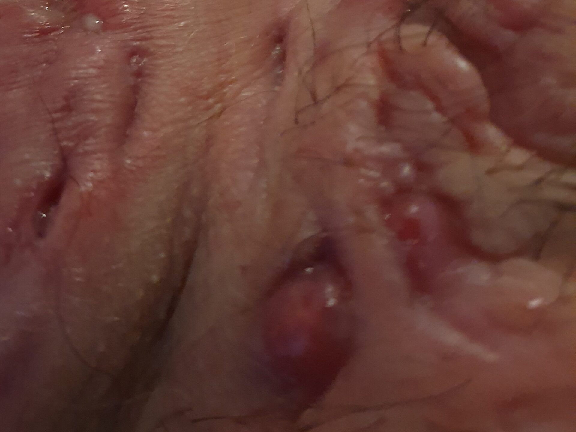 Hypergranulation Hidradenitis suppurativa wound care