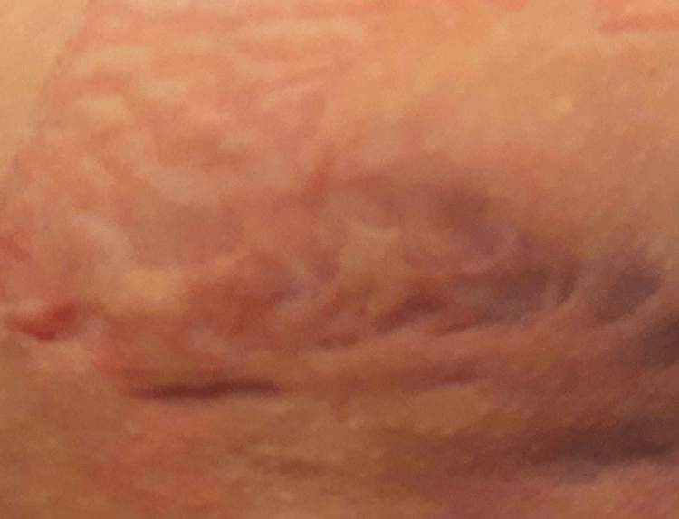 Adhesive skin damage thigh