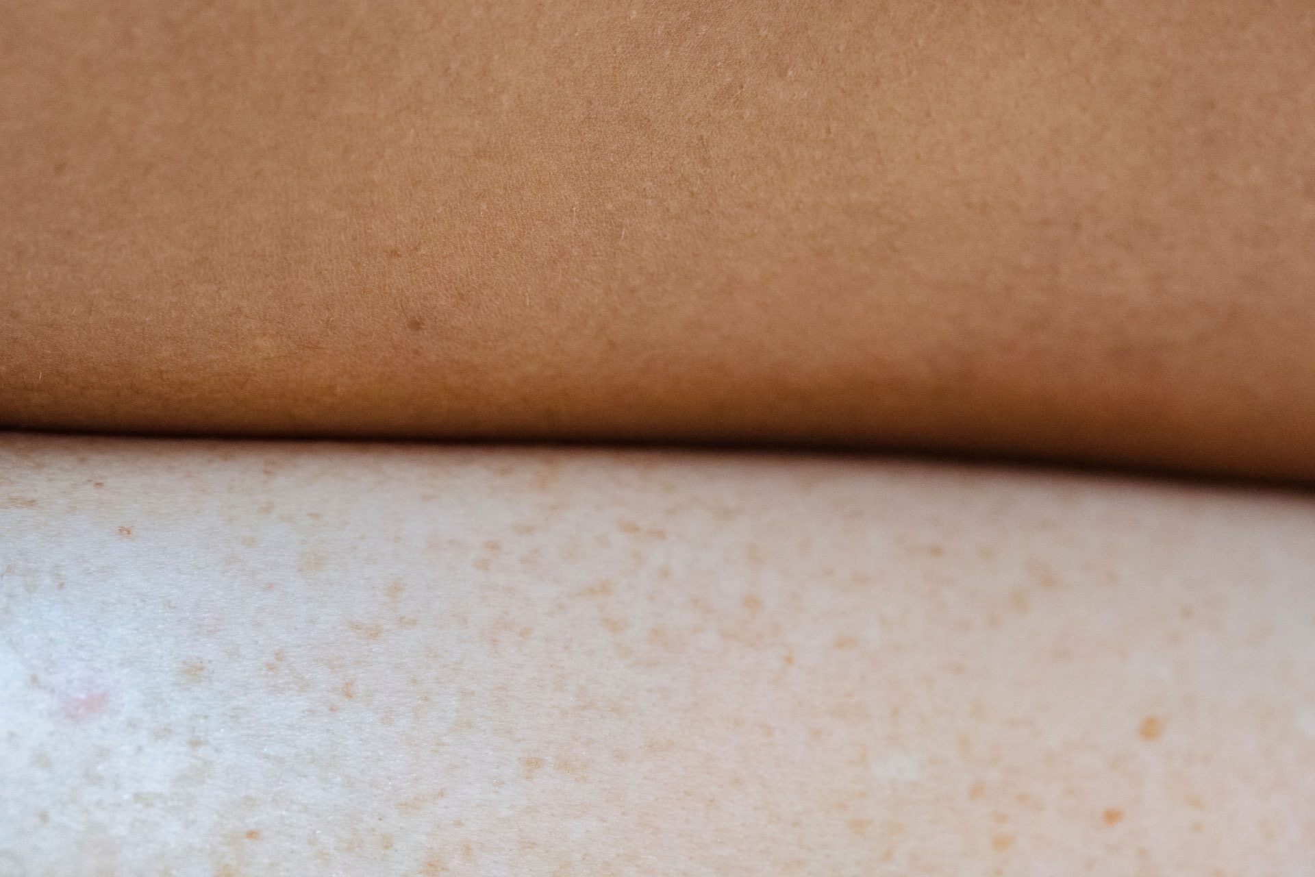 Hidradenitis Suppurativa Wound Care (Part 1): How to Clean and Protect Your Skin
