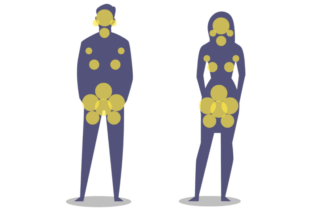 Areas of the body affected by hidradenitis suppurativa wounds that need wound care