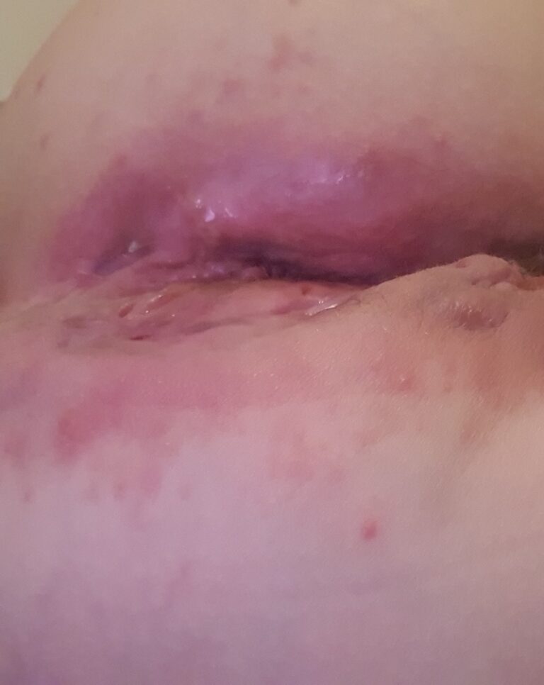 Hidradenitis suppurativa flare on the buttocks and coccyx