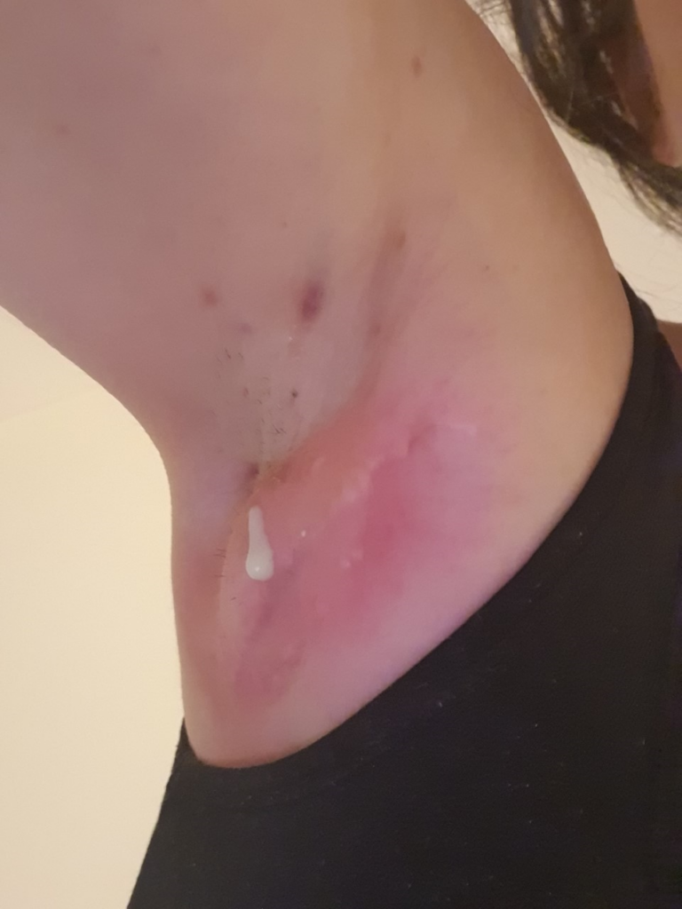 Hidradenitis suppurativa wound and abscess in the underarm (axilla)